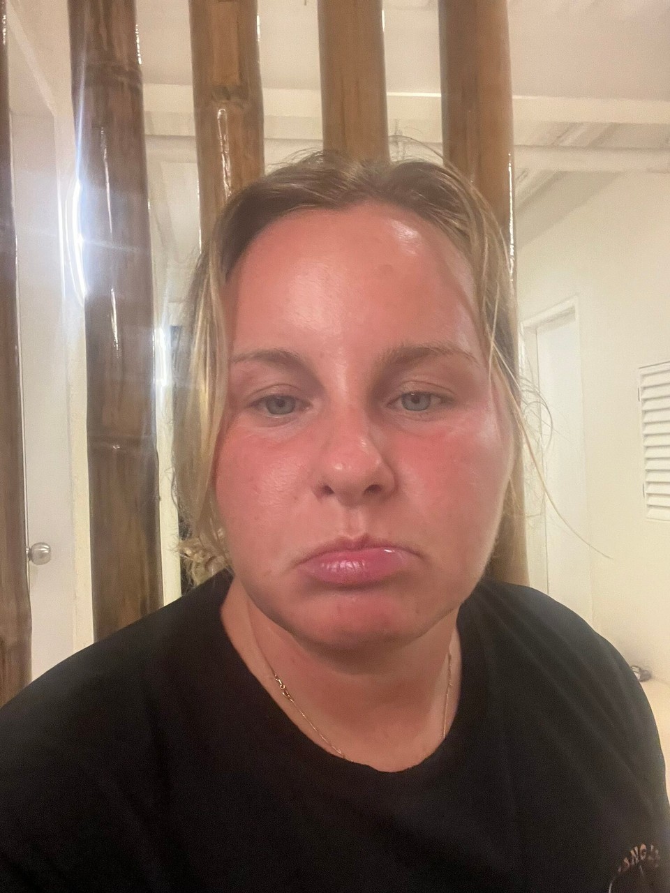 Philippines - General Luna - A very burnt Ellie. I mean I had 50 on my face! 