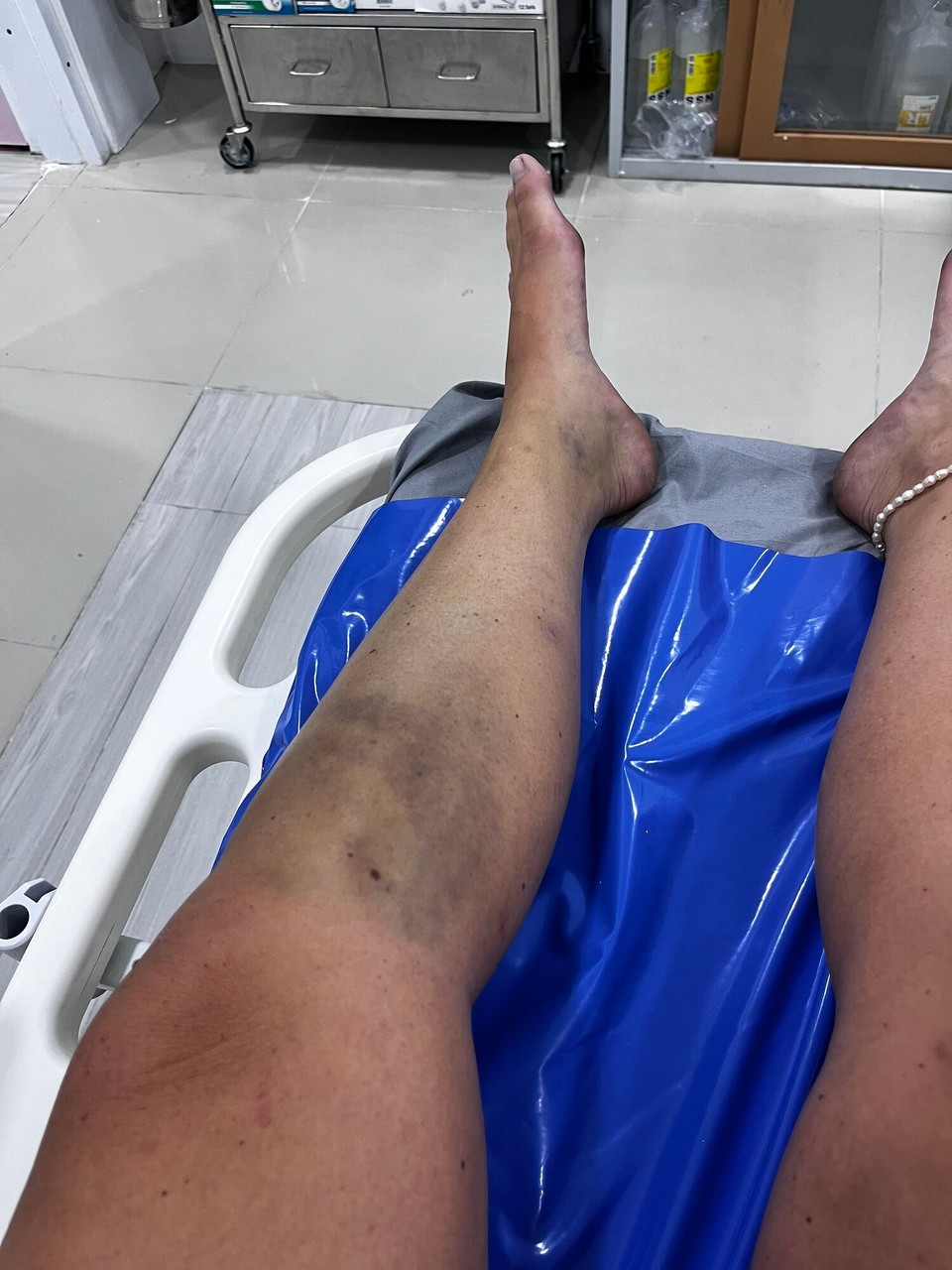 Thailand - Mueang Satun - The fact I’m not in the hospital for my leg ahahah 
