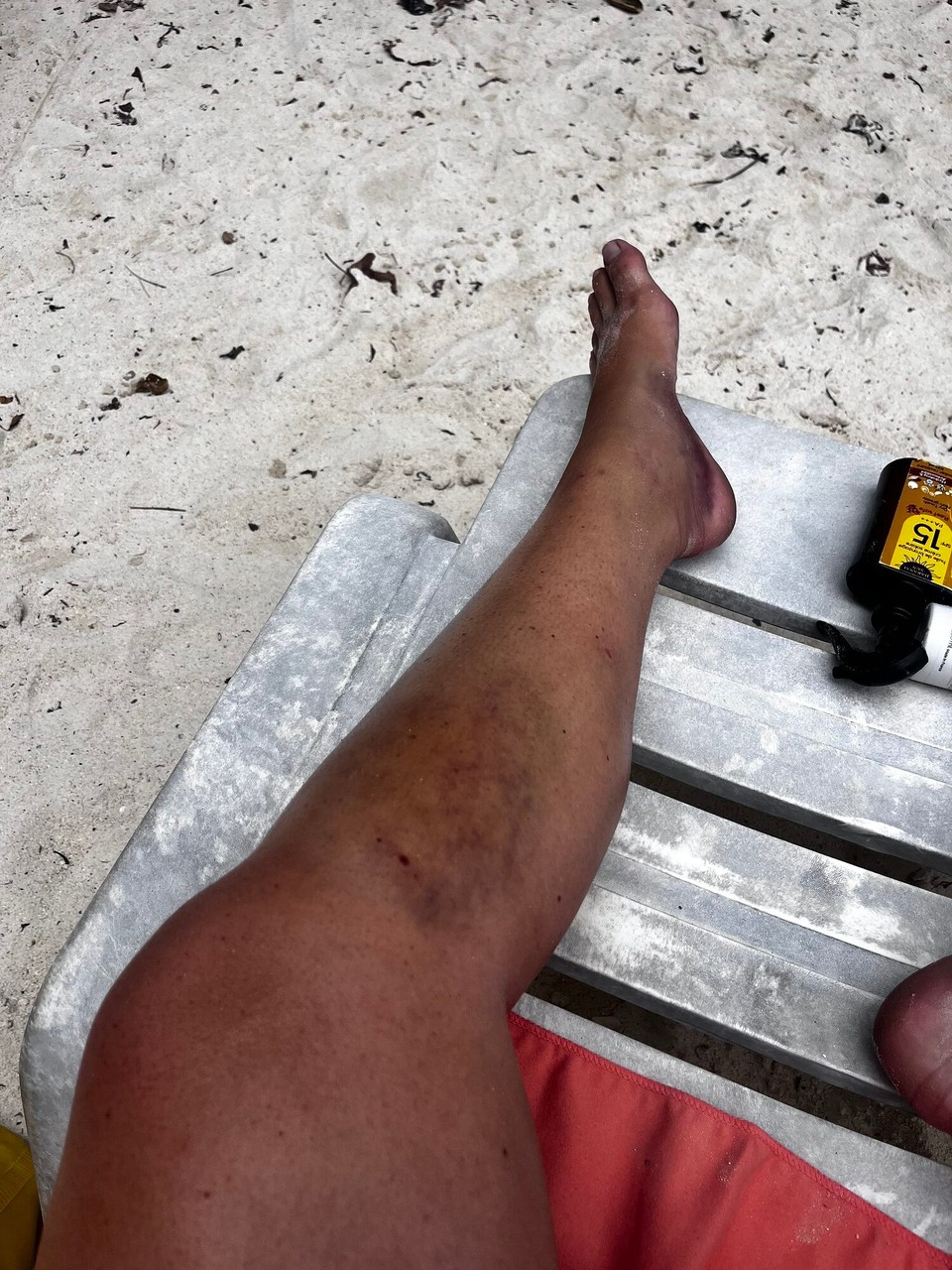 Thailand - Mueang Satun - Leg update, it now hurts 
