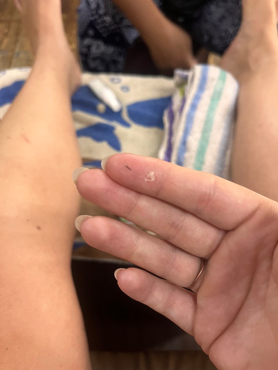 Malaysia - Malacca - This little bastard has been in my foot for weeks and was making my toe swell. Thai doctors are actually shit 