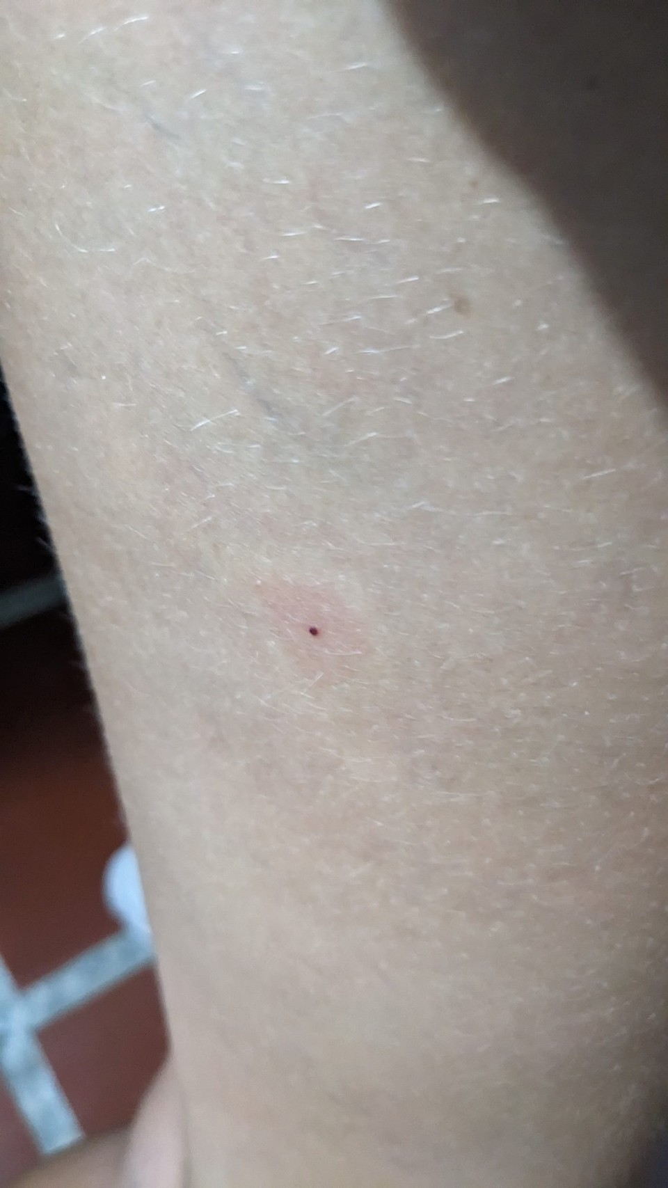 Kolumbien - Minca - Die Touristen nennen sie Minca-Legs... Die Sandmücken verursachen Stiche mit kleinen blutigen Punkten, die nach ein paar Tagen ein sehr typisches Bild abgeben. Da ich weiß, dass die Dinger Leishmaniose übertragen, bin ich leider so gar nicht darüber erfreut, dass ich schon welche habe..