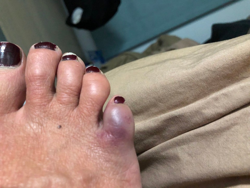 Neuseeland - Rotorua - Dummerweise habe man ich meinen kleinen Zeh verletzt, eigentlich sollte ich den Fuss wohl still halten. 