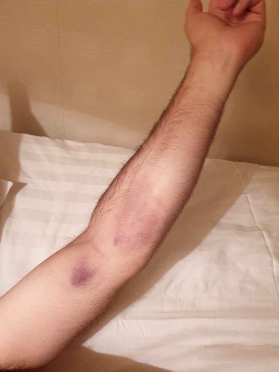 Mongolia - Murun - The bruises to prove Luke is now a "Mongolian Man"