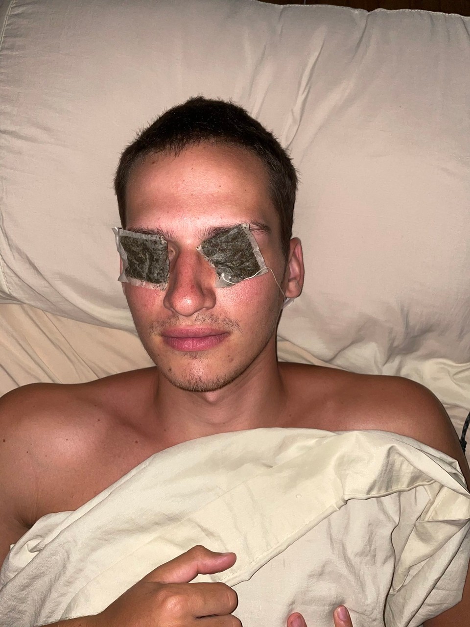 Costa Rica -  - Teebeutelaugenmaske gegen schmerzende Coronaaugen. Geholfen hats